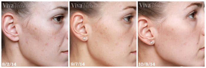 Rodan + Fields Unblemish